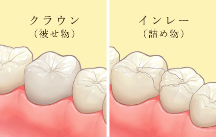 クラウン（被せ物）/インレー（詰め物）